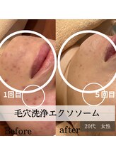 パルティノ 高崎店/５回目症例・20代・ニキビケア