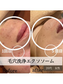 パルティノ 高崎店/５回目症例・20代・ニキビケア