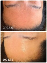 セルベッラ(cerbella)/小顔艶肌ボンバーフェイシャル