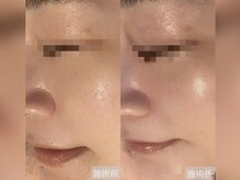 ハイフン(HIFUN)/ララピールLDM毛穴洗浄