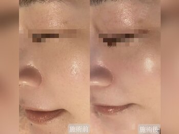 ハイフン(HIFUN)/ララピールLDM毛穴洗浄