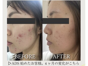 アンソレイエ(ENSOLEILLE)/医師提携肌改善プログラム　ADS