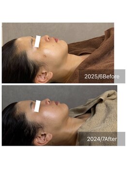 サロン グリッター 新宿(Salon GLITTER)/【肌質改善】ビフォーアフター