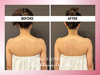 リスブランビューティー(Lys Blanc Beauty)/９０分コルギBefore×After