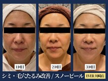 エヴァーグレース 川崎店/たるみ改善に人気のピール美容!!