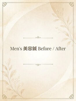 長寿鍼灸院 長寿整骨院/men's美容鍼実例