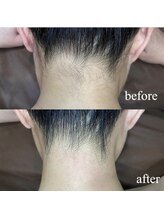 ユウユウ(YUYU)/襟足脱毛　WAX＋LED脱毛