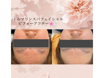 サロンド ユニバース(salon de universe)/トルマリンスパフェイシャル