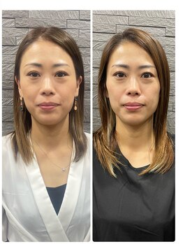 長寿鍼灸院 長寿整骨院/ハリネズミ女優美容鍼効果★