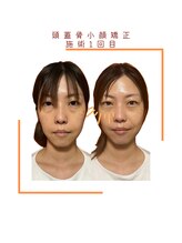 ヴィヴァーチェ(VIVACE)/頭蓋骨小顔矯正ビフォーアフター