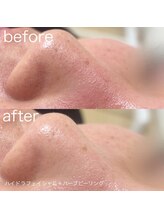 ルルラ リコ(lulula rico)/症例写真/ハイドラ毛穴洗浄