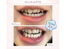 エクシアホワイトニング 調布店/30代女性会員様/1回目