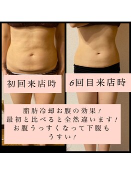 ティアメディカル(Tia Medical)/脂肪冷却5回の効果