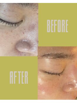 ルサンク(le cinq)/毛穴改善例