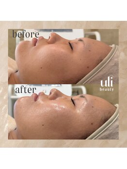 ウリ(uli beauty)/比較写真