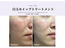 【白玉ホイップトリートメント】美白成分グルタチオンの濃密な泡でのマッサージは最高に気持ちいいです♪