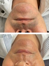 エアリアル 大川店/ヒゲ脱毛