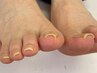 【巻き爪矯正1カ所】2回目以降の方　¥6,600