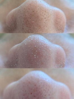 エイチビールーム(H:be Room)の写真/当店イチオシ☆【韓国式3D毛穴洗浄◇初回限定:¥7700】毛穴の開き・詰まりが気になる方にオススメ◎