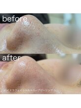 ルルラ リコ(lulula rico)/症例写真/ハイドラ毛穴洗浄