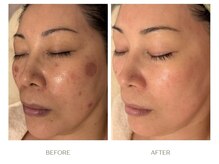 途中経過（Y様40代・施術2回/期間1ヶ月）