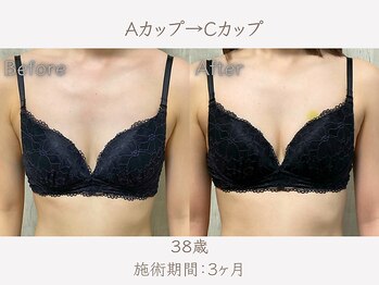 ハリスタ 六本木院(HARISTA)/3ヶ月間でAカップ→Dカップ