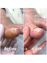 縦に折れた巻き爪が1回目の変化