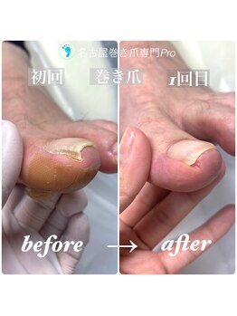 名古屋巻き爪専門Pro/縦に折れた巻き爪が1回目の変化