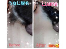 ルアナ(Luana)/うなじ脱毛☆