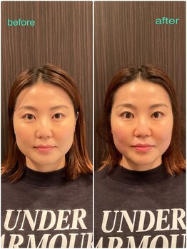 はる鍼灸整骨院/30代女性｜1回の結果