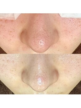 エクラ バイ シャンリィ(eclat by shanLy)/皮脂汚れ詰まり取ります!