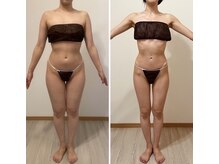 プリマ(prima)/ダイエット症例