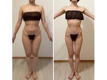 プリマ(prima)/ダイエット症例