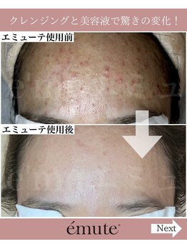 エムケーサロン(MK salon)/普段のスキンケアを変えただけ!