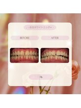プラスビー 2号店(+b)/ホワイトニングビフォーアフター