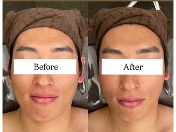 美容整体 レナトゥス 武庫之荘(Renatus)/黄金比フェイシャル 1回施術