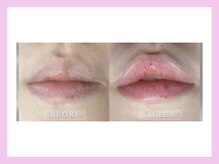 キワミビューティ(KIWAMI BEAUTY)/ローマピンク　唇　症例