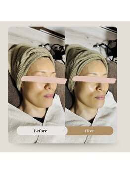 ルブラン(Le blanc)/before&after