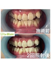 ルブラン 奈良店(Le Blanc)/15分2回連続ケアとなります