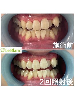 ルブラン 奈良店(Le Blanc)/15分2回連続ケアとなります