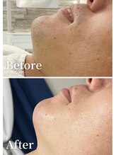 ビーラボ(Be-Lab.)/メンズ脱毛1番人気のヒゲ脱毛♪