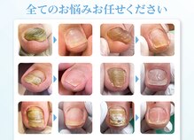 東京巻き爪補正店