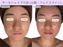 ラエッセ(La Esse)/お顔の幅・小顔へ変身させちゃう