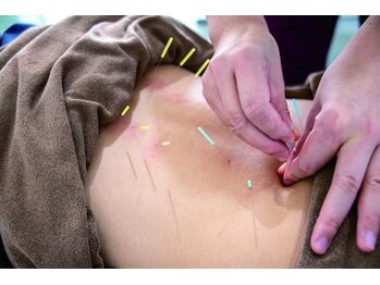 J.アスリートケア メディカル鍼灸マッサージ院/施術例3