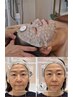 【当店最高峰】100分 完璧リフトフェイシャル 炭酸×ヒト幹細胞×EMS