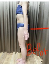 エスポリー(ESPORY)/痩身施術前