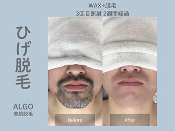 アルゴ 山口宇部店(ALGO)/頑固な髭も6回でこの仕上がり!