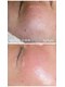 プローサム(Prorsum)の写真/マツヤニとクレイで産毛・古い角質・頑固毛穴汚れを徹底除去！ツヤとトーンがアップしたなめらかなお肌に◎