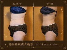 セオリー(Theory)/お腹Before→After