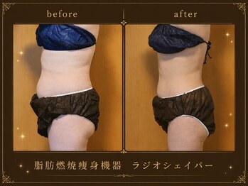 セオリー(Theory)/お腹Before→After